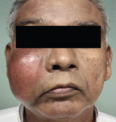 Patient with swelling on the right cheek.